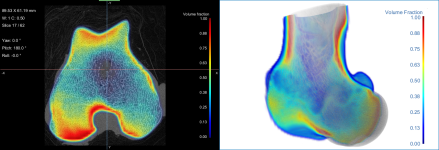Volume fraction of a proximal femur